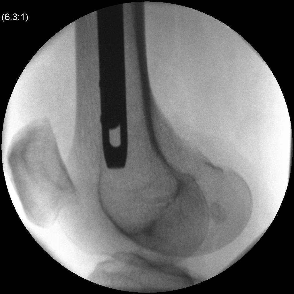 Femoral Nail Distal Locking0001